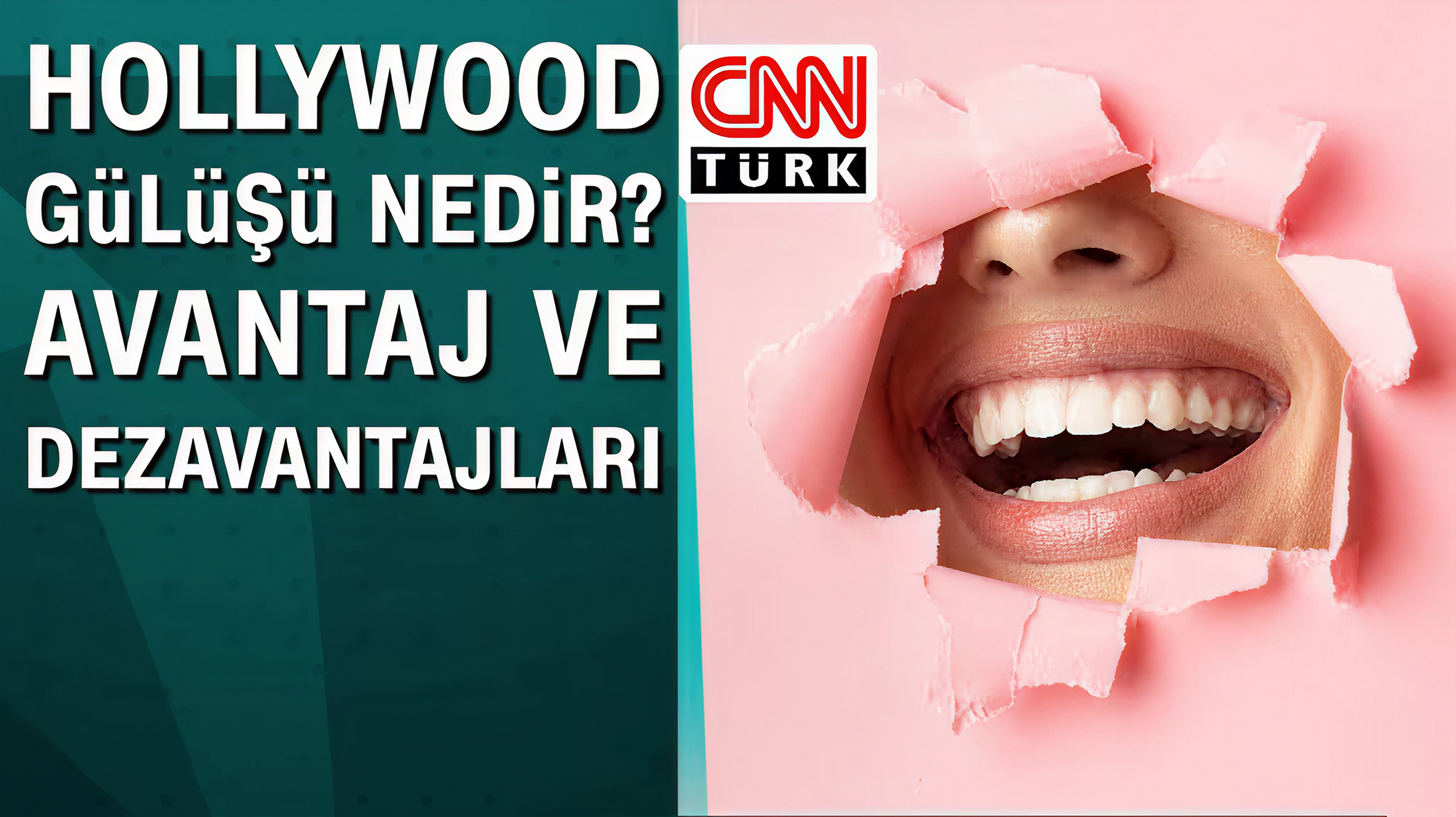 Hollywood gülüşü nedir? Avantaj ve dezavantajları nelerdir?