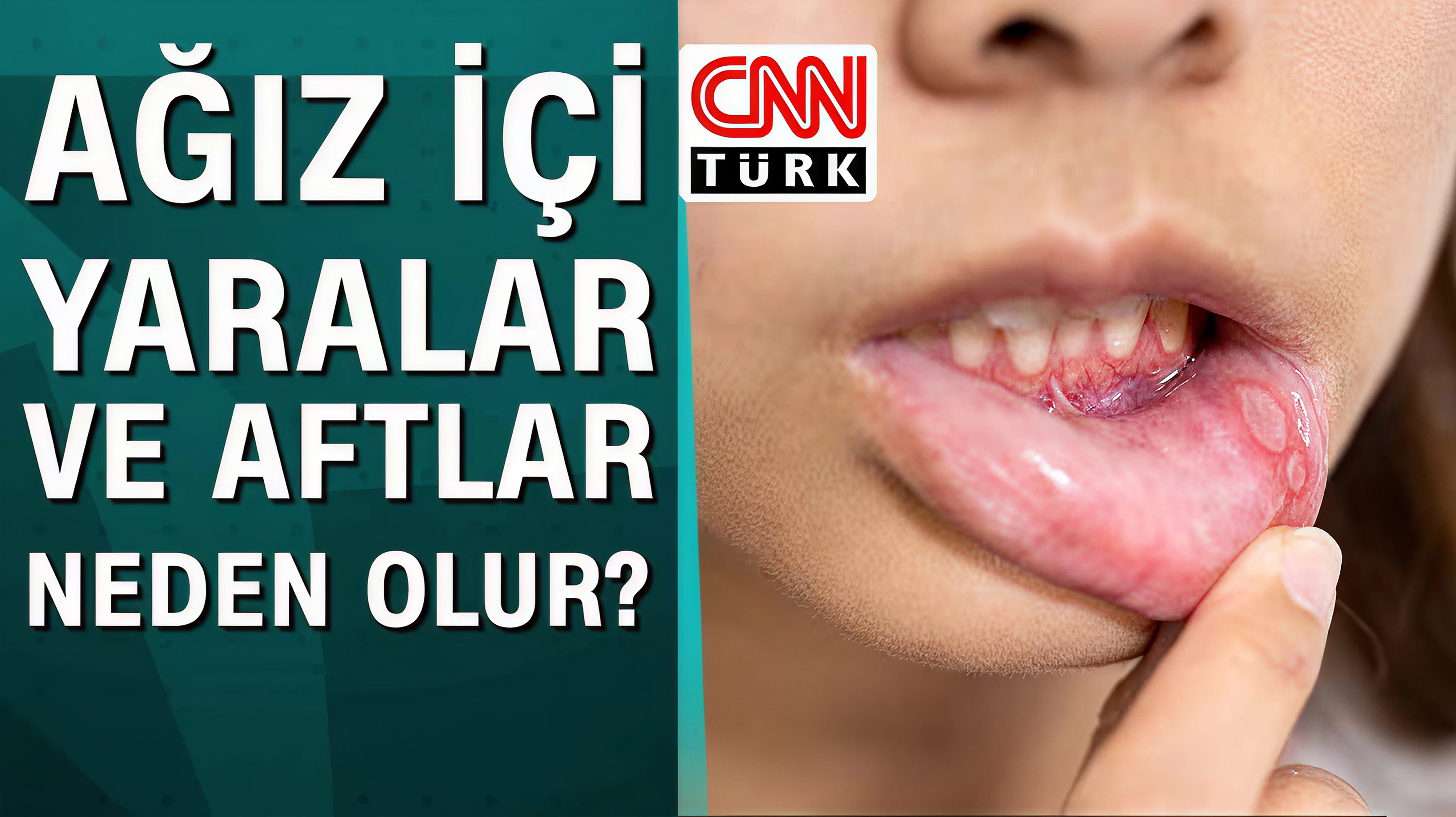Ağız içi yaralar ve aftlar neden olur?